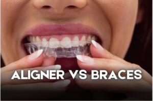 aligner-vs-braces