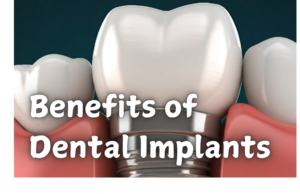 dental-implants-in-pala