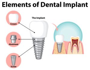 dental-implant-in-pala