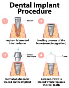 dental-implants-in-pala