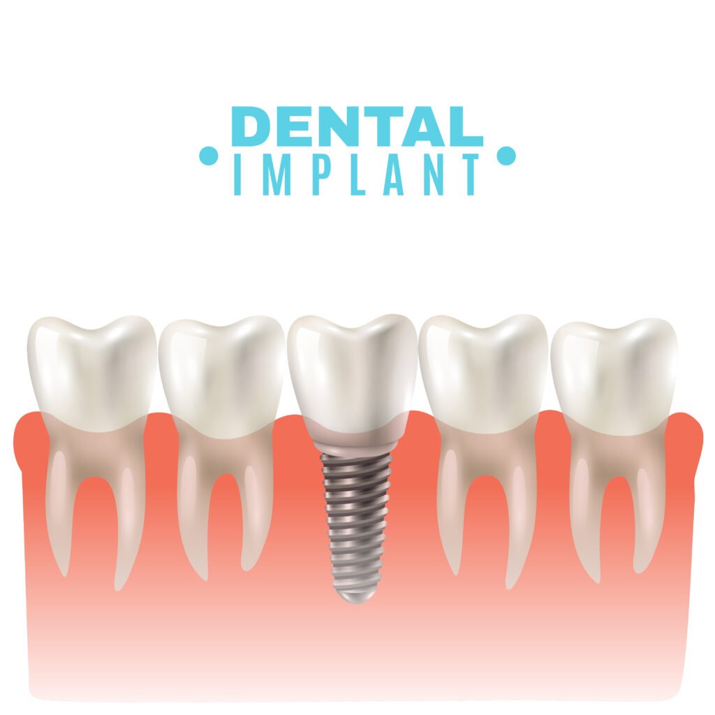 dental-implants